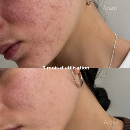 Duo Anti-Imperfections